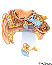 Ear infectionsInfecciones de los oídos